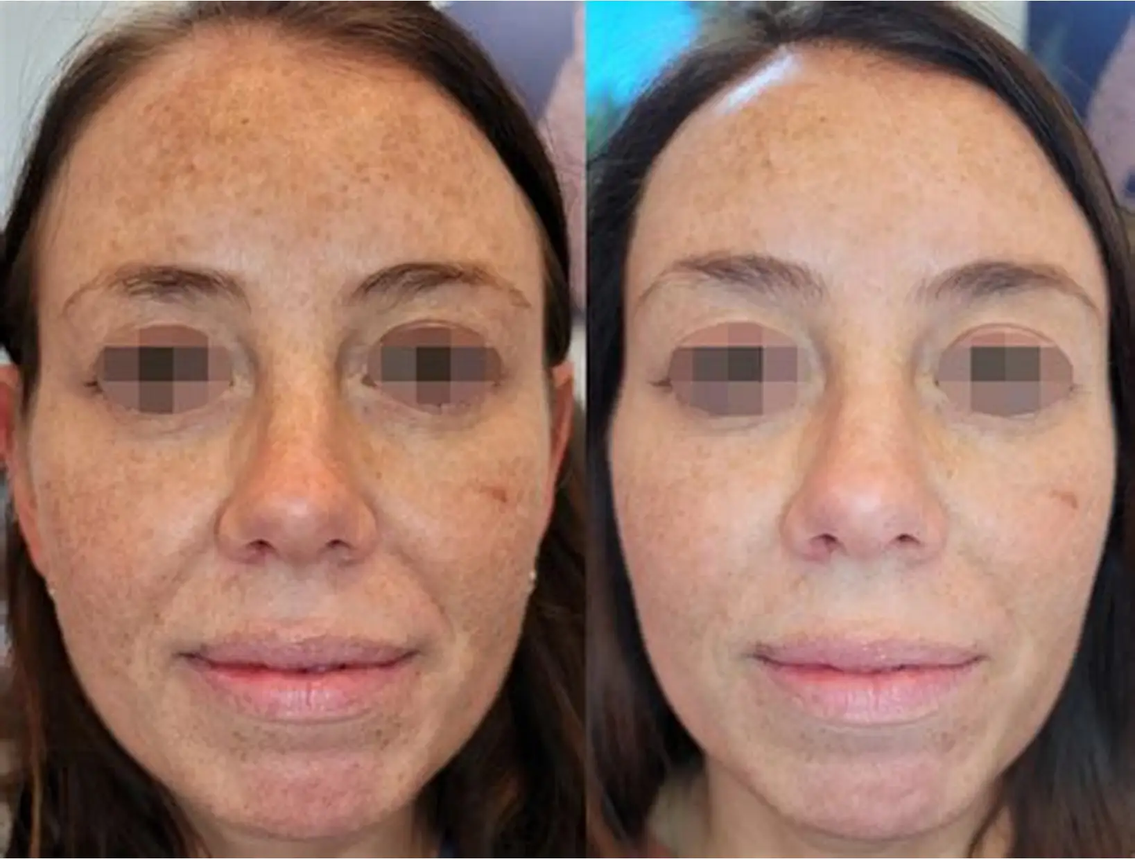 Peeling Milk Peel au Centre Laser du Chalonnais